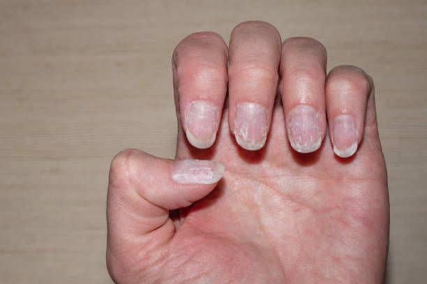 Quels compléments alimentaires pour les ongles dédoublés ? - haute ...